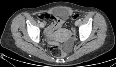 Clear Cell Carcinoma Arising in an Abdominal Wall Cesarean Section Scar: A Case Report With Description of Pathological and Molecular Features